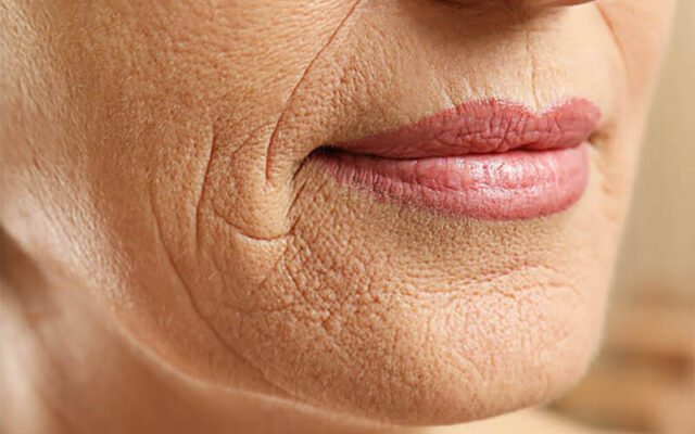 Száj körüli ráncok eltüntetése InstaTense Plus szérummal