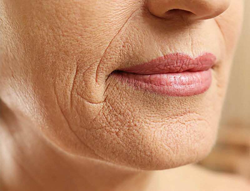 Odstránenie vrások okolo úst pomocou séra InstanTense Plus